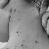 Chicken Pox
