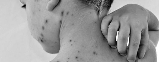 Itchy chickenpox