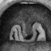 Diphtheria