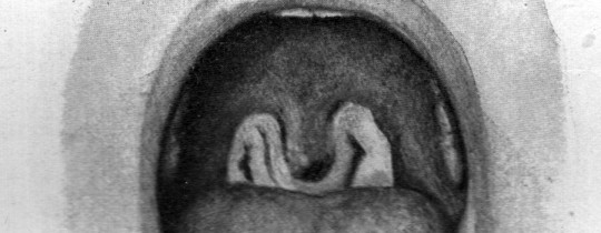 Diphtheria illustration of throat