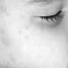 Mumps