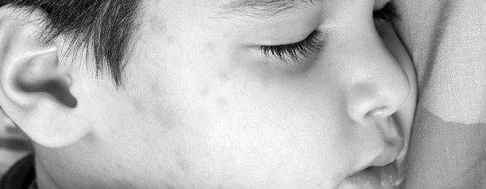 Boy with Mumps