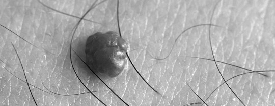 Papilloma