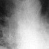 Pneumococcal Infection