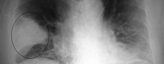 Pneumococcal - strep - PneumonisWedge09