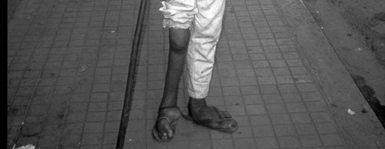 Polio - an affected leg