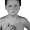 Rubella