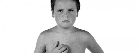 Sick boy child
