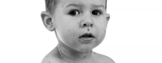 Little boy whit smallpox