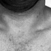 Typhoid
