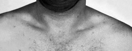 Rose spots on the chest of a patient with typhoid fever