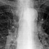 Tuberculosis