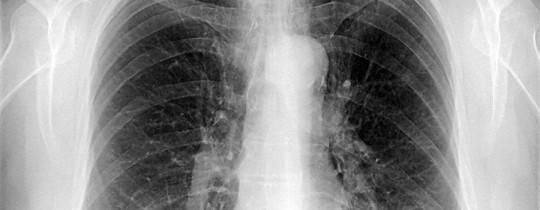 X-Ray Image Of Human Chest
